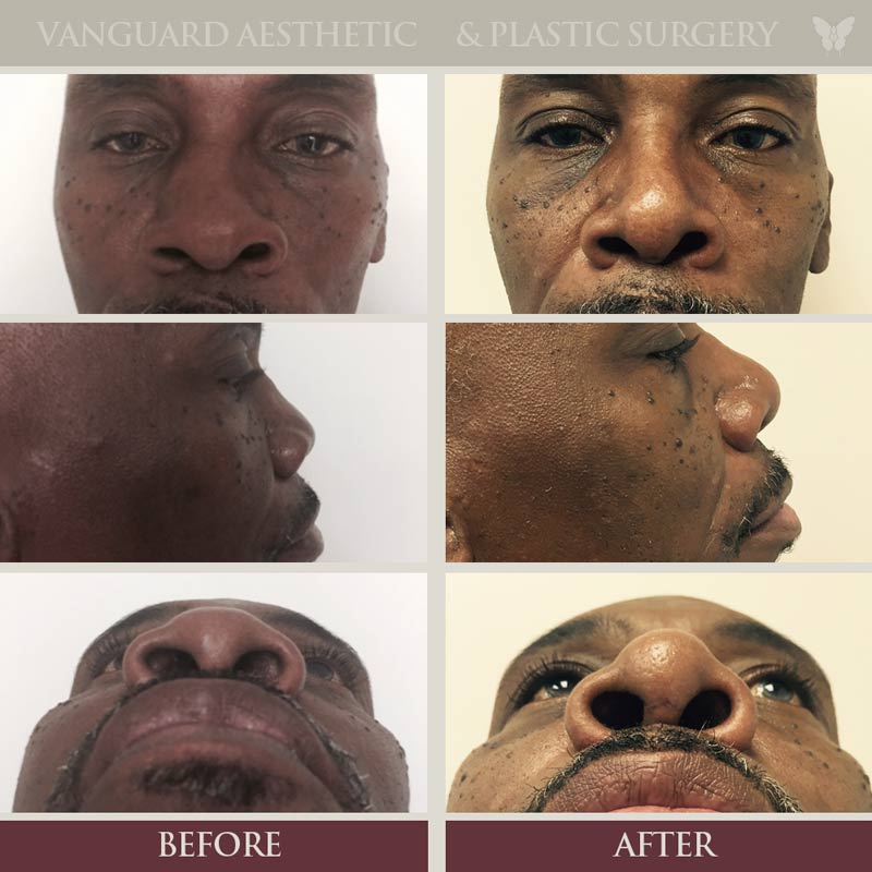 Before and after of african american man with rhinoplasty surgery