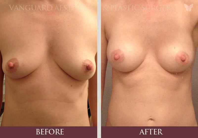 Before and after photo of 30 year old woman who received a breast lift