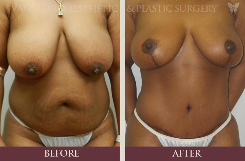 Abdominoplasty Surgery Cost
