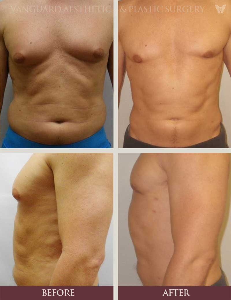 florida plastic surgery surgeons gynecomastia before and after