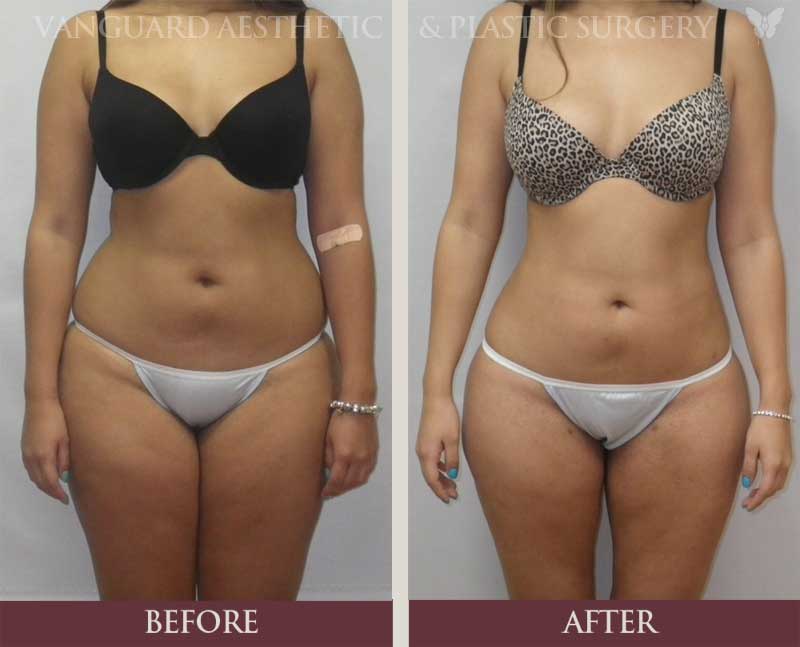 florida plastic surgery before and after liposuction 