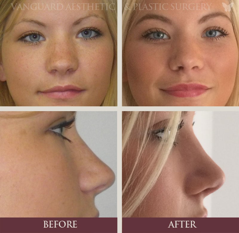 florida plastic surgery rhinoplasty nose job before and after