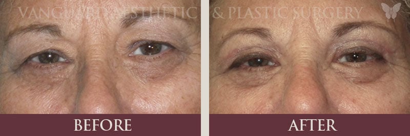 florida eye lid lift blepharoplasty before and after