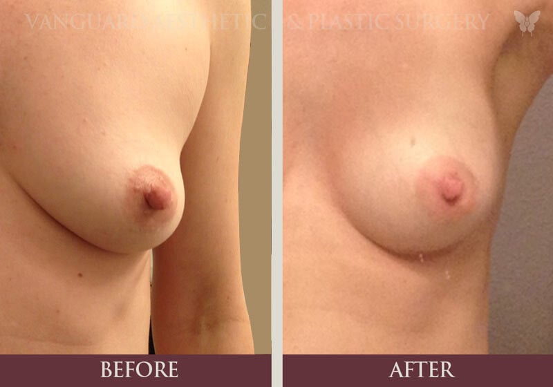 Before and after shot of a woman with nipple reduction surgery