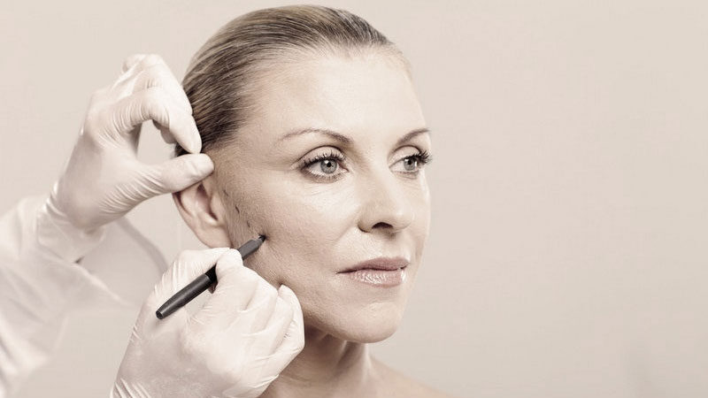 What is a Facelift?