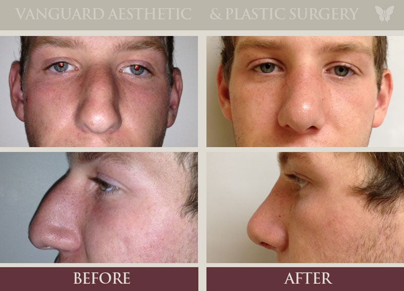 Photo before and after of caucasian man with rhinoplasty surgery